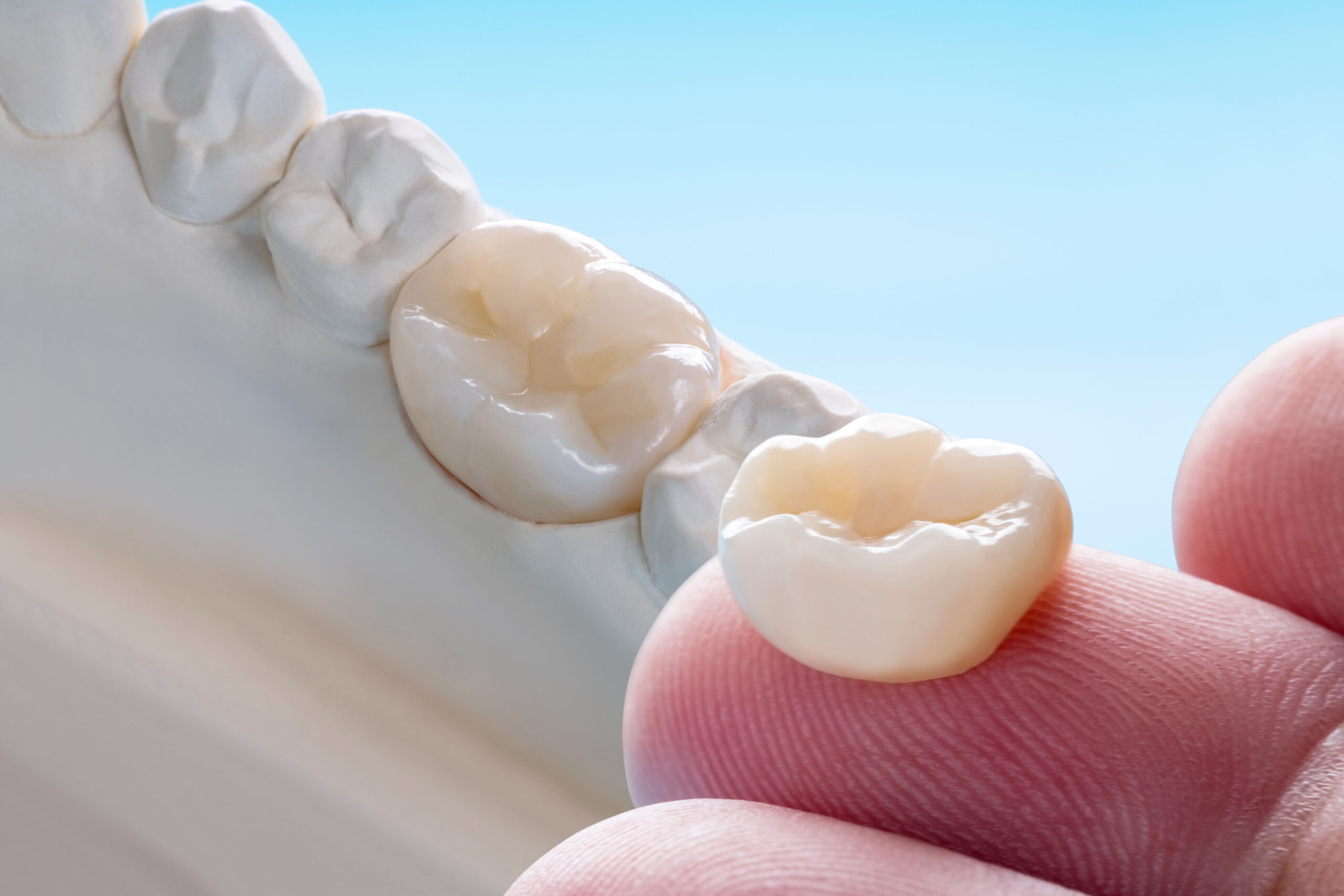 same-day crowns in Richardson, TX